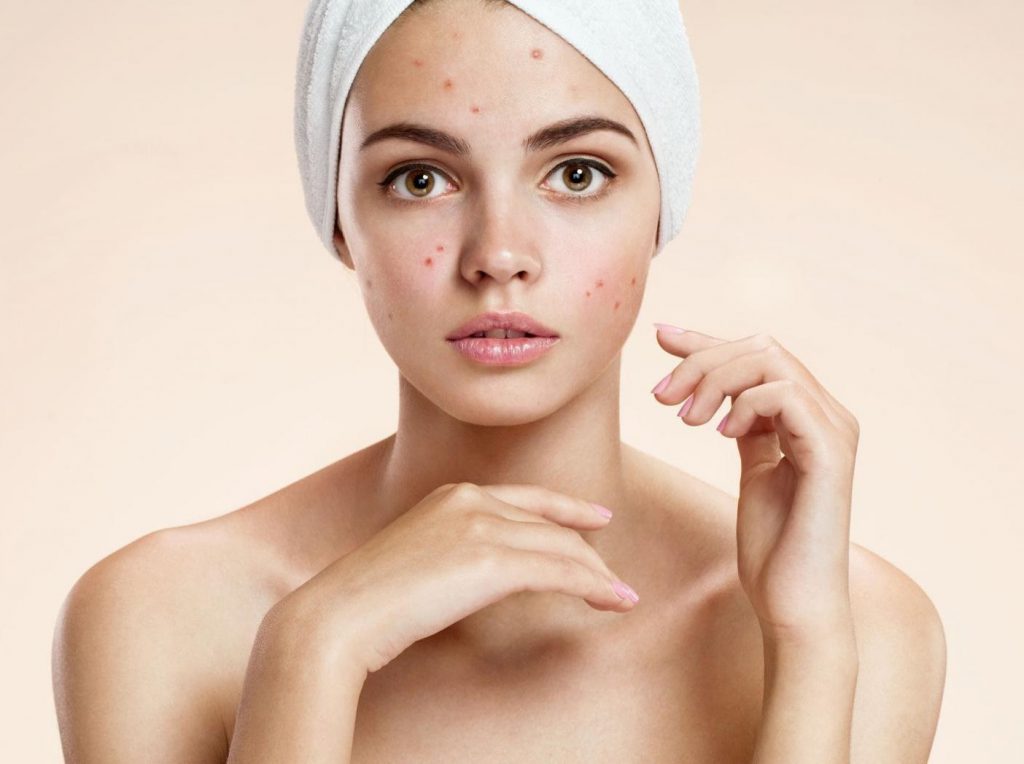Ce se utilizează şi cum se îngrijeşte pielea afectată de acnee?
